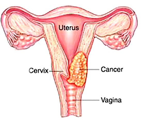 Cervical cancer in uterus