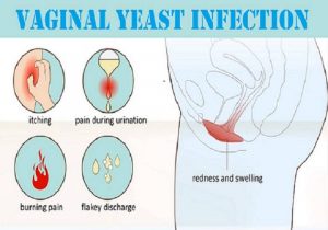 Infection Vagina 