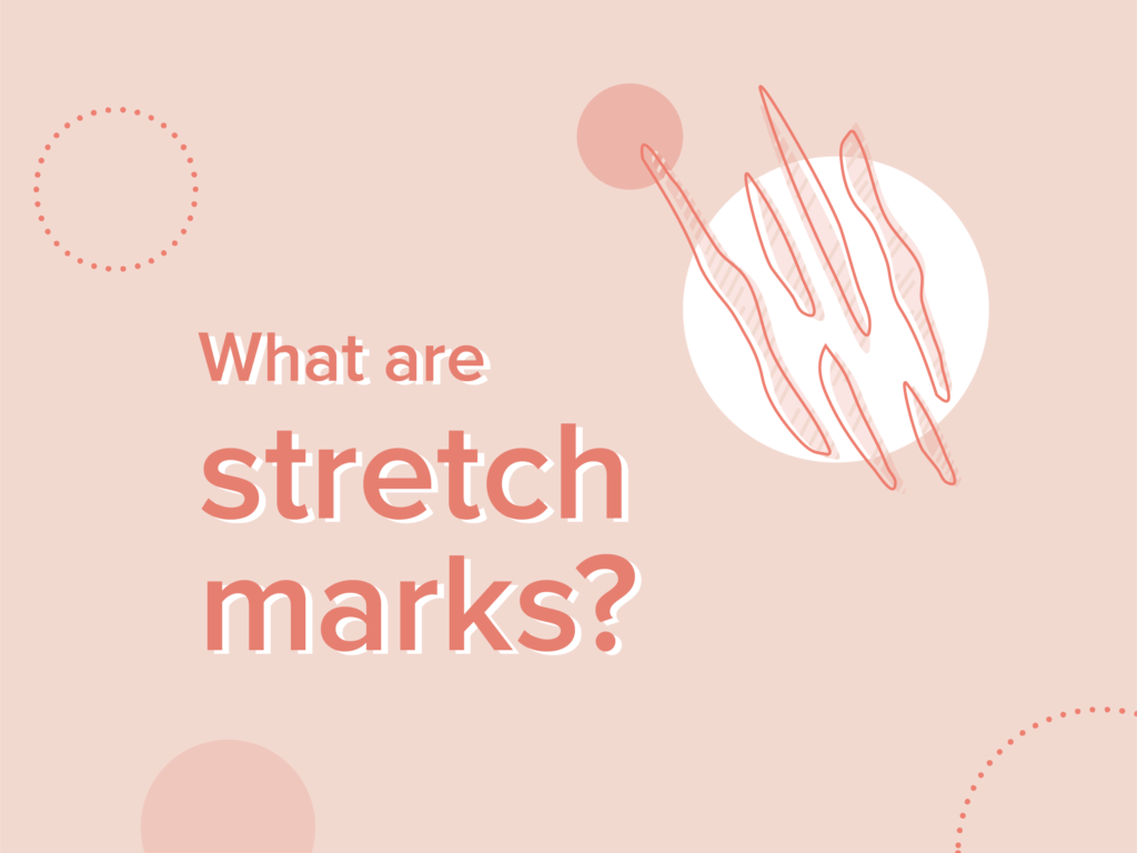 what are stretch marks?