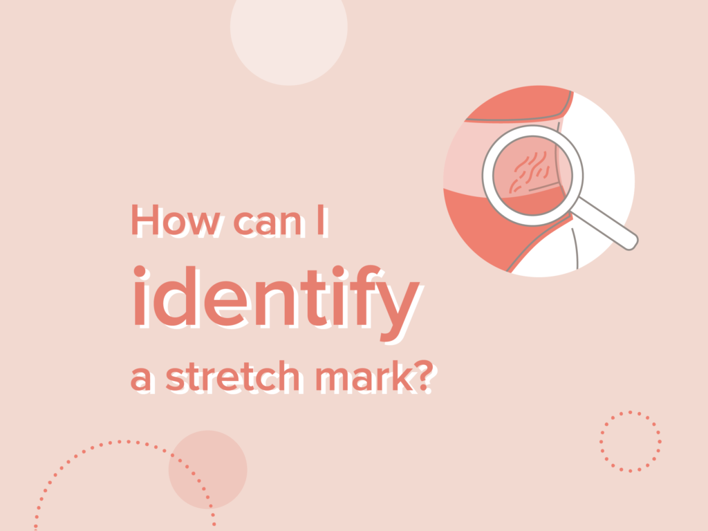 Identify stretch marks