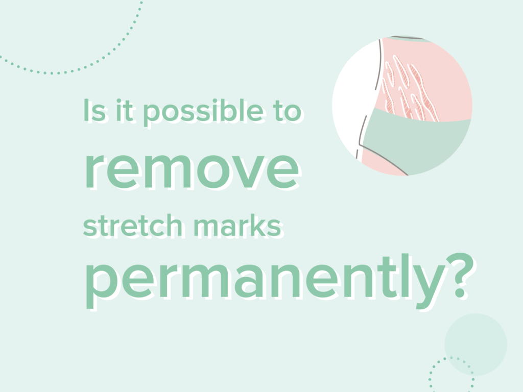 removing deep stretch marks