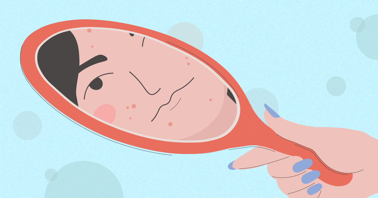 Period acne A comprehensive guide