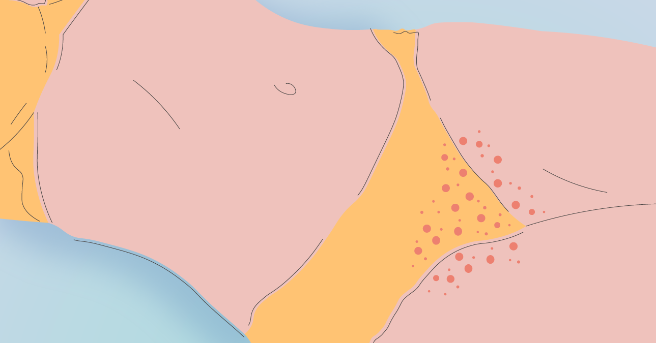 Heat Rash Periods Period Rash from Pads? Causes, Relief Tips & How to Avoid It