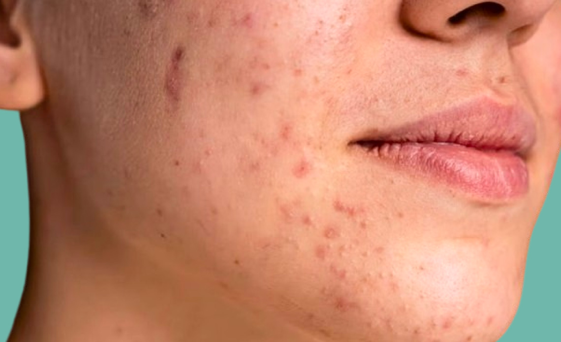 A close up photograph of a woman's cheek with adult acne
