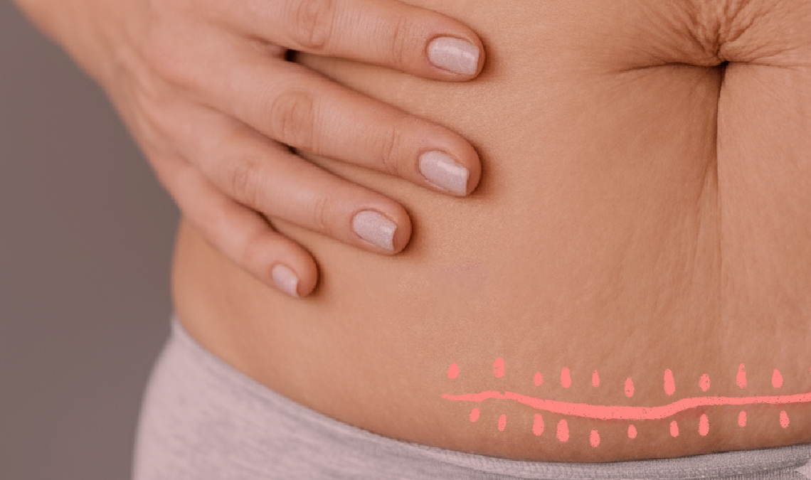 An image of a woman's belly with a c-section scar on it